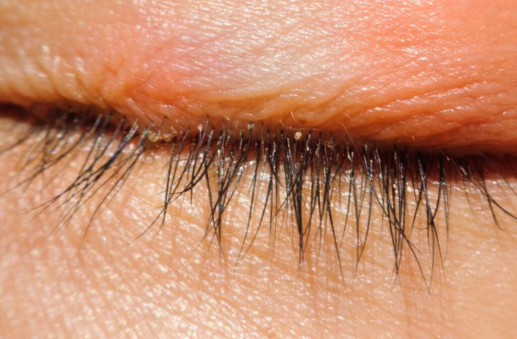 Close up of an eyelash line that has blepharitis