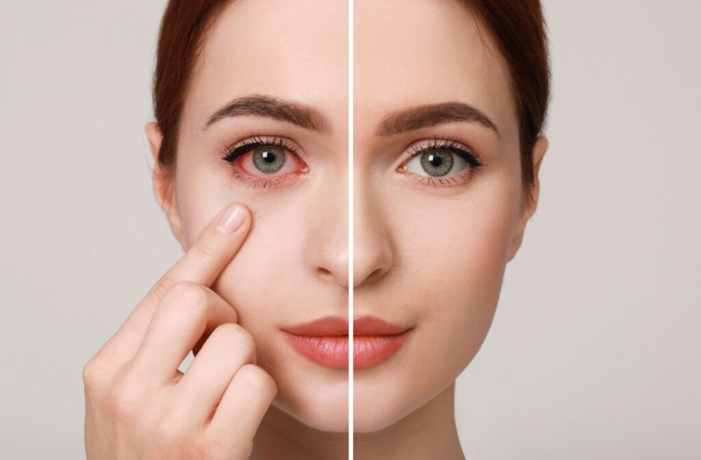 Split image of a person's face showing a healthy eye and a red irritated eye